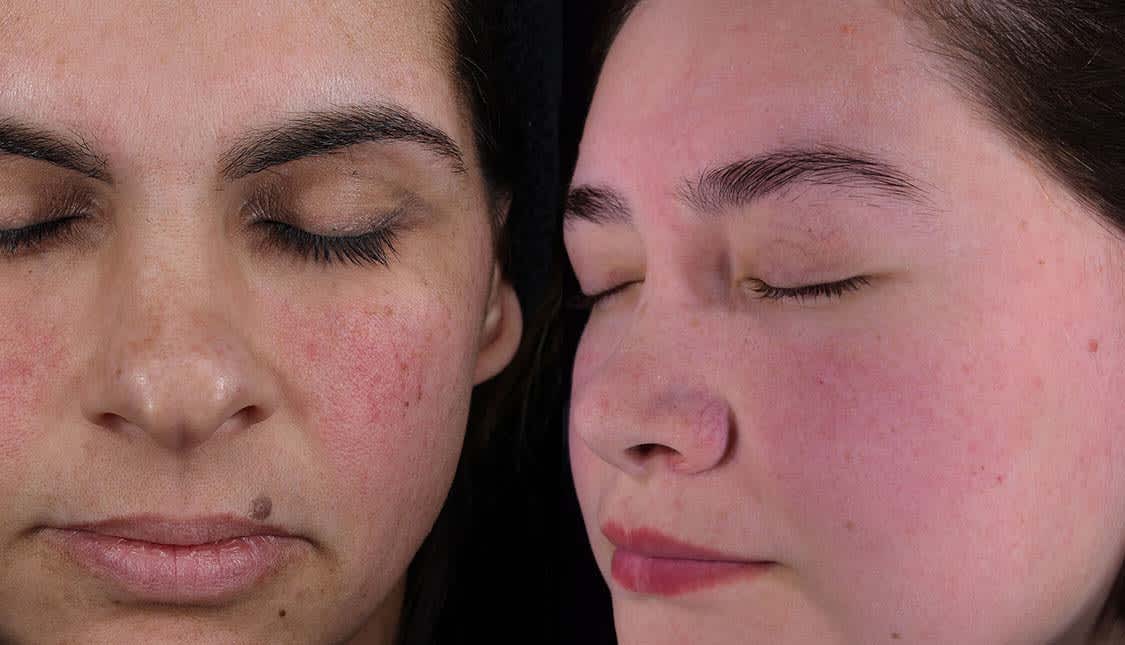 Skin with rosacea