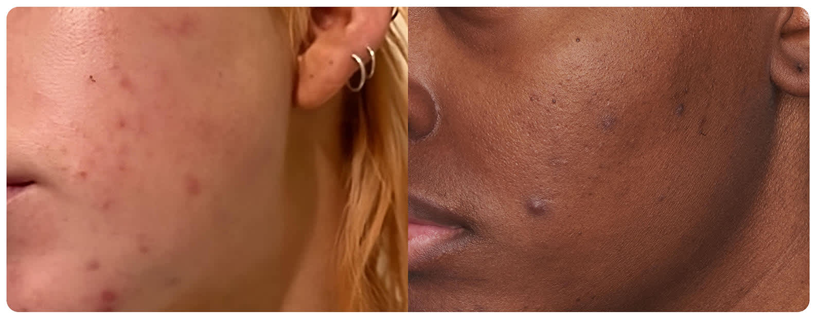 Selection of Clear products to address breakouts